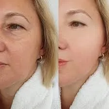 Cómo la tecnología potencia tratamientos regenerativos como el PRP y Sculptra