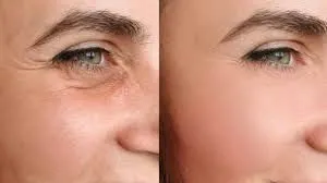 HIFU facial: energía focalizada para redefinir firmeza y contorno